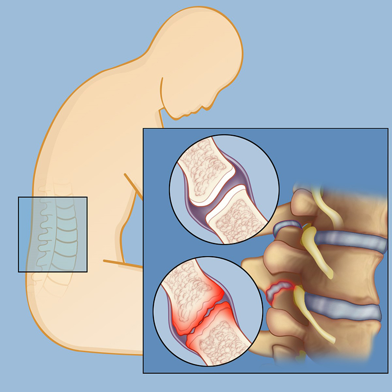 Facet Syndrome | Weill Cornell Brain and Spine Center